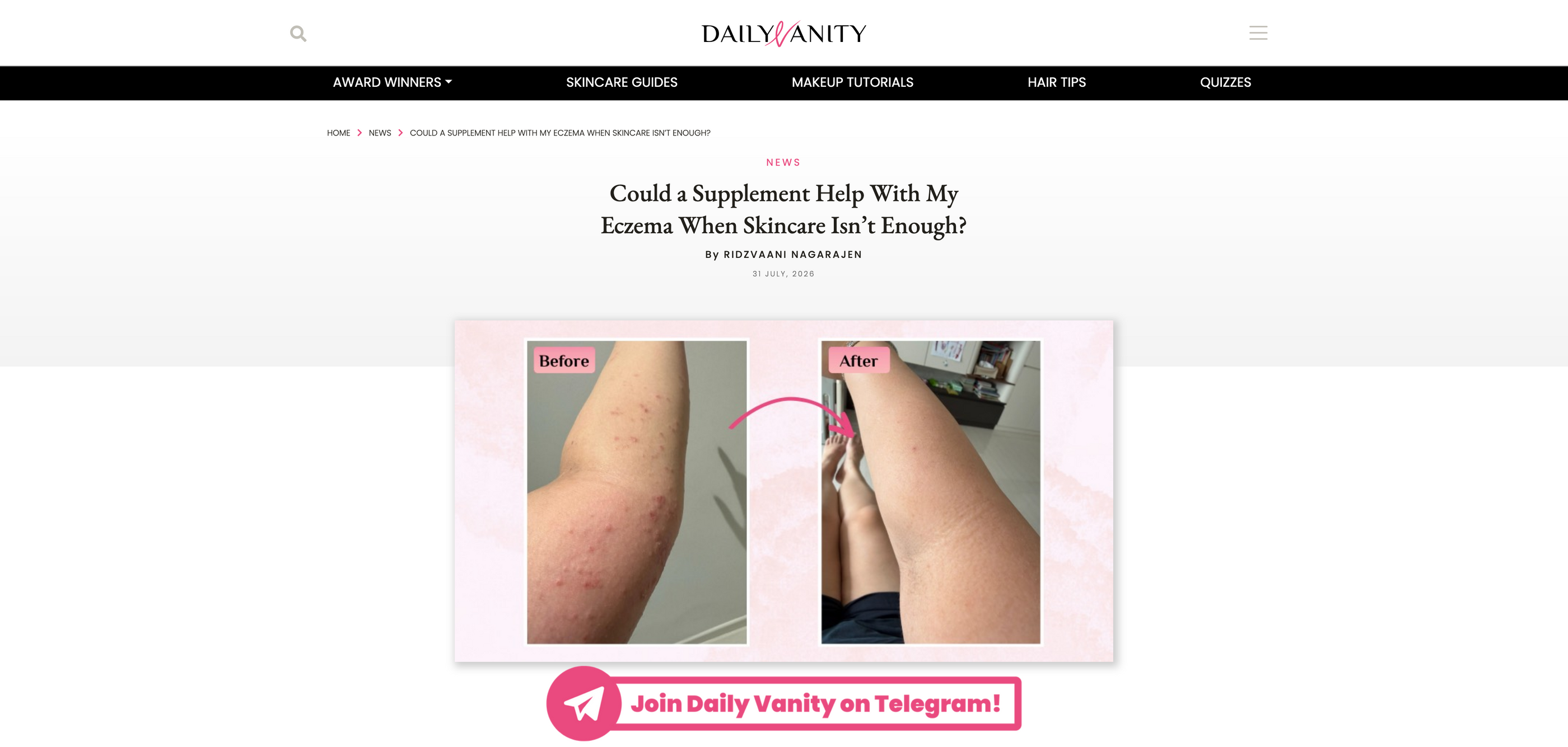 Could a Supplement Help With My Eczema When Skincare Isn’t Enough?