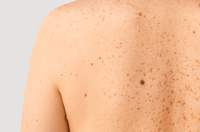 Understanding Skin Cancer Symptoms: Early Signs You Shouldn't Ignore