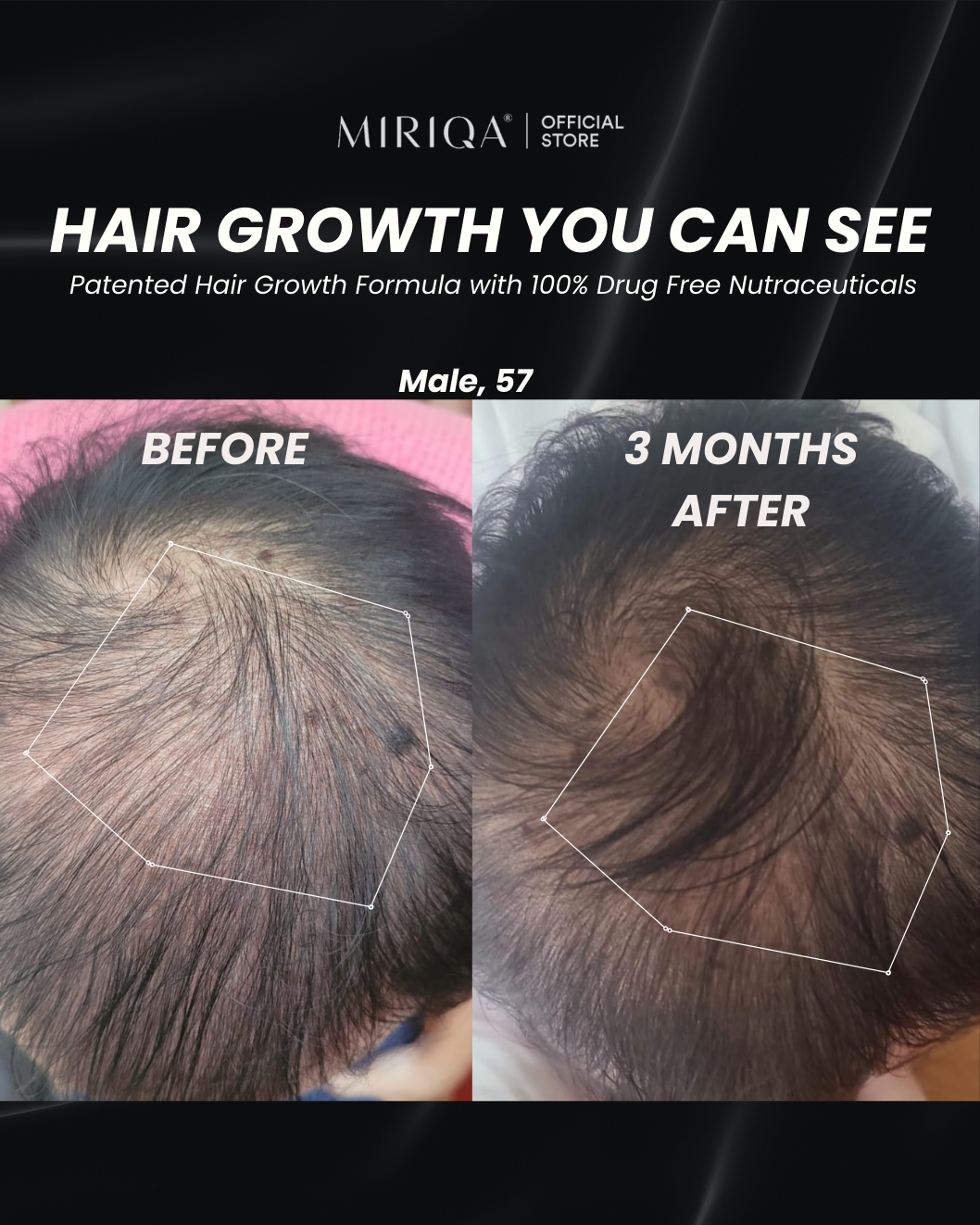 MIRIQA Hair Supplement - Hair Growth You Can See